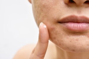 Acne and face skin problem, Woman applying acne cream medication, Topical pimple gel drug treatment.