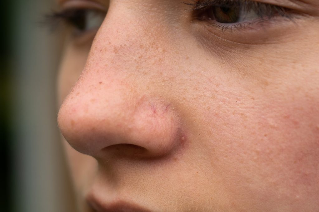 Photo of rosacea skin condition