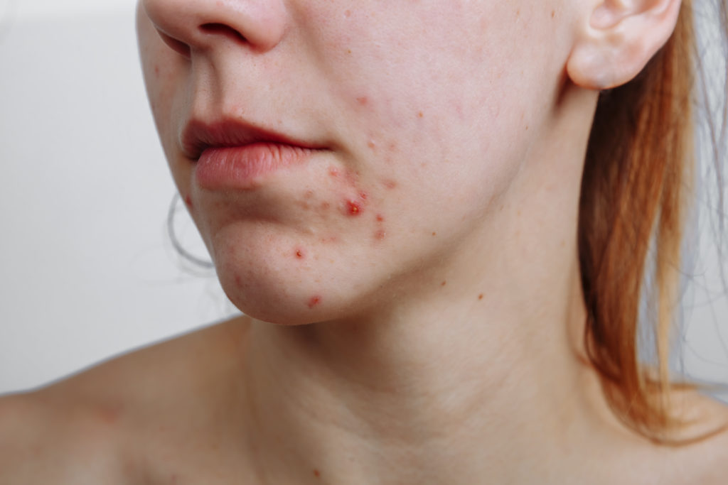 Image of women with acne